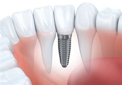 Pasos En La Terapia De Implantes Cl Nica Dental Mozas