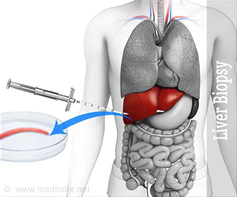 After Liver Biopsy What Position