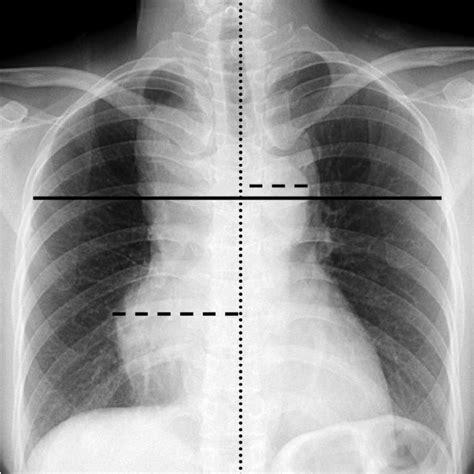 Chest X Ray Pa Upright Shows A Bulky Mediastinal Mass Encasing The Download Scientific Diagram