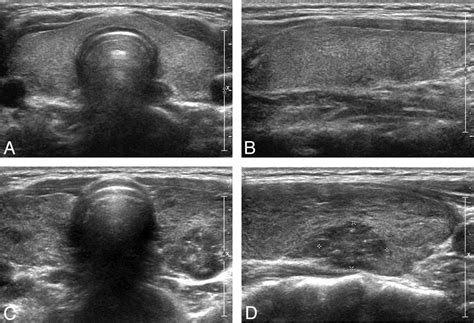 Normal Thyroid Ultrasound