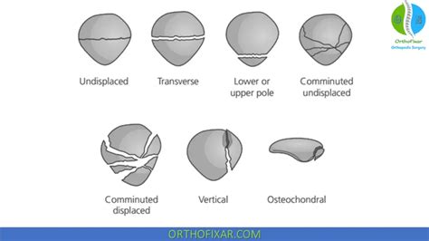 Patellar Fractures | Broken Kneecap | OrthoFixar 2025