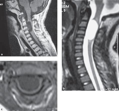 Figure 1 From Unusual Presentation Of Cervical Spinal Intramedullary