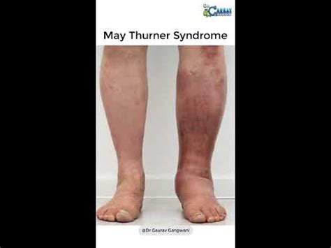 Swollen Feet Ankle Swelling Leg Swelling May Thurner Syndrome