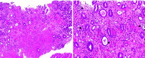 Histological Examination Of Gastric Mucosal Biopsy H E Stain A