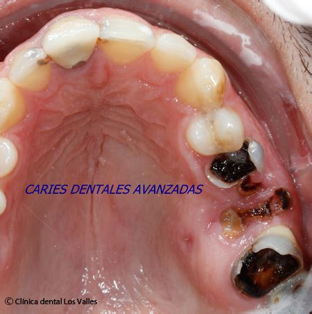 Endodoncia Multirradicular Sin Extracciones