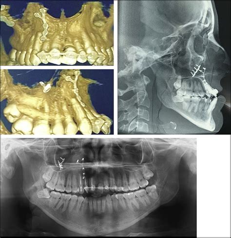 Pretreatment Tomography And Panoramic And Lateral Cephalometric