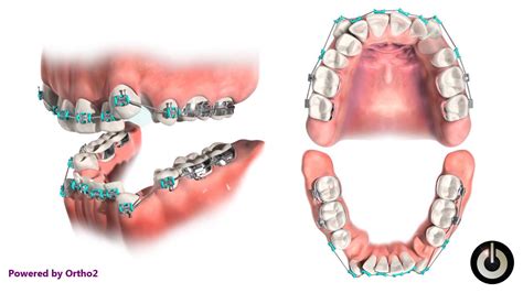 4 First Premolar Extraction For Crowding Youtube