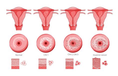 Estágios Do Câncer Cervical E Morfologia Celular No Exame De