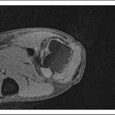 Preoperative X-ray of the right thumb (lateral). | Download Scientific Diagram