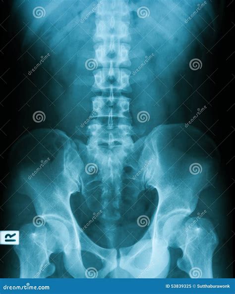 X-ray image of Plan KUB. stock image. Image of kidney - 53839325