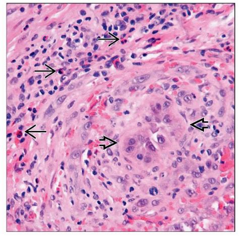 Angiolymphoid Hyperplasia With Eosinophilia Basicmedical Key