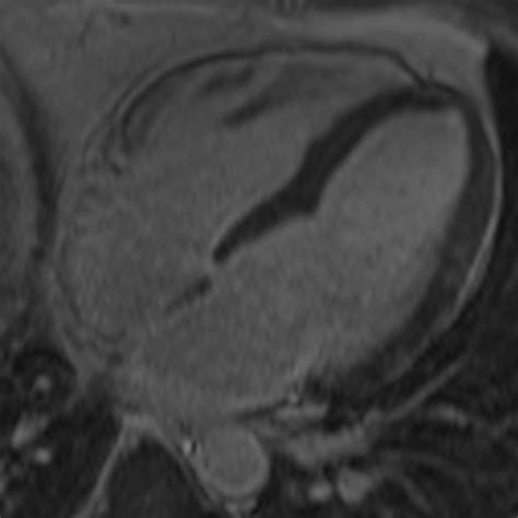 Cardiac Mri Of Lyme Disease Myocarditis Heart