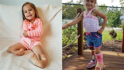 3 Year Old Born With Backward Legs Takes First Steps After Pioneering Surgery Fox News