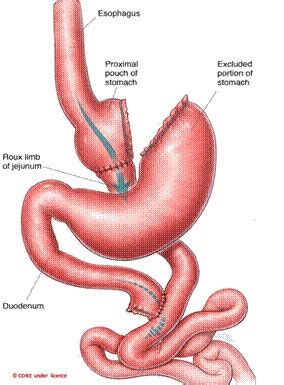 Gastrojejunostomy