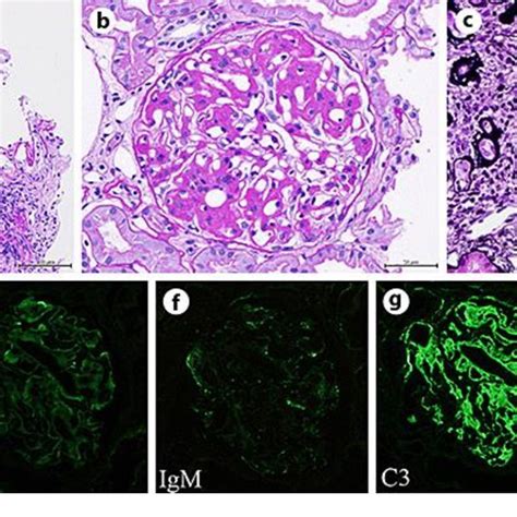 Lm Findings Of Renal Biopsy Specimens A Glomerular Global Sclerosis