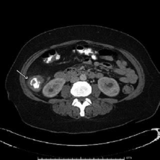 (PDF) An Apple-core Lesion in the Colon: An Infectious Etiology