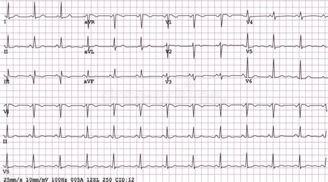 Chest Ecg Leads Placement Illustration Six Colored Electrocardiography