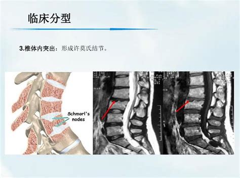 腰椎间盘突出症的诊治方法和预防 好医术早读文章 好医术 赋能医生守护生命