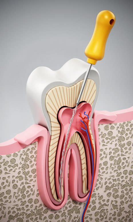 Je Vous Raconte Mon Exp Rience Avec Un Endodontiste