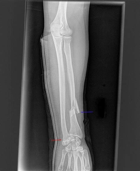 Image: Galeazzi Fracture - MSD Manual Professional Edition