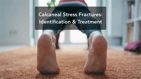 Calcaneal stress fractures: Identification and treatment - RunningPhysio