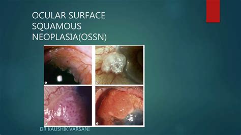 Ossn Ocular Surface Squamous Neoplasia Ppt