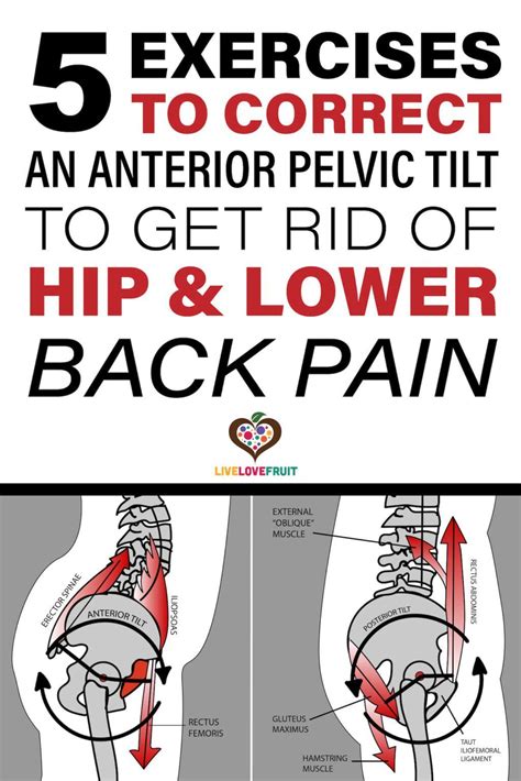 7 Anterior Pelvic Tilt Exercises To Fix Painful Lower Back Artofit