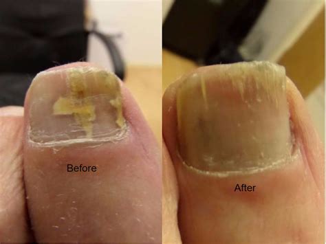 Fungal Nail Laser Uk Footsteps Chiropody Podiatry Services