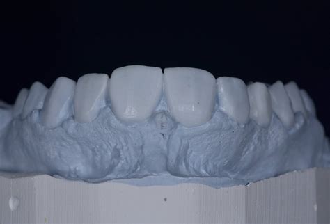 Dental Esthetics Ovate Pontic For The Correct Emergence Profile A