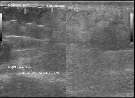 Gluteal Abscess