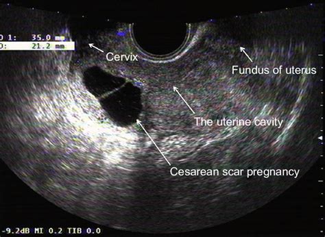 Uterine Cavity Ultrasound