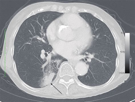 Preoperative Chest Computed Tomography Showing A Tumor Involving The