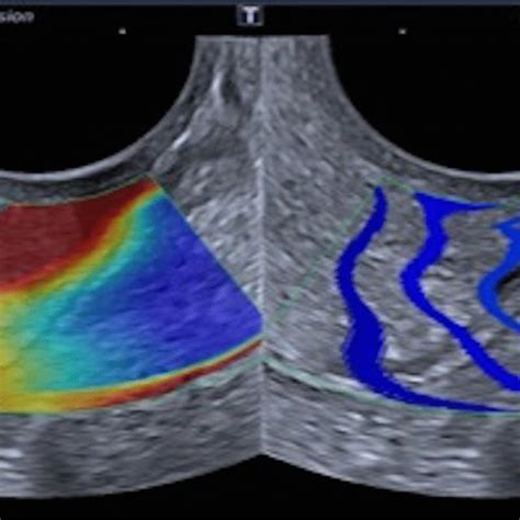 Shear Wave Elastography Swe Indicative Of Overpressure Peripheral Download Scientific