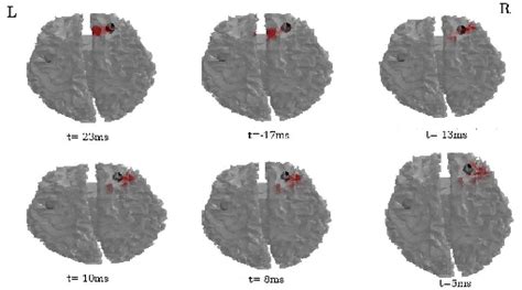 Sloreta Combined Emeg Source Reconstruction For Nd Eeg Nd Meg