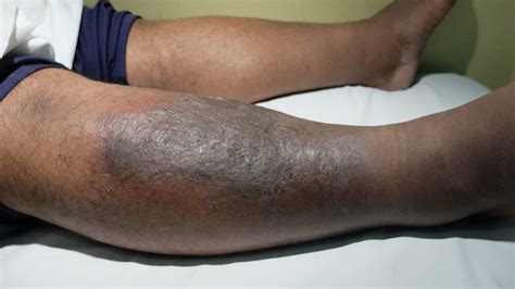 Cellulitis Infection Foot