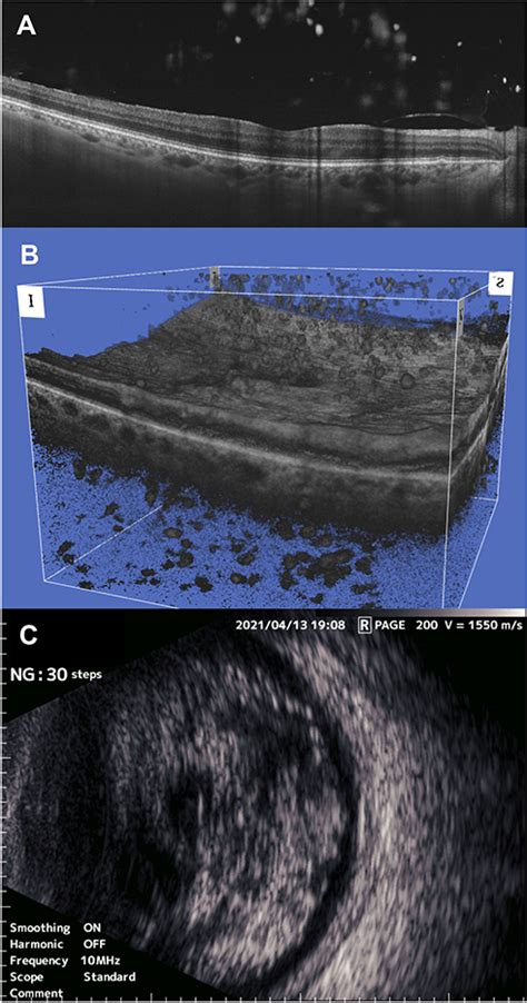 Spotlight On Asteroid Hyalosis Clinical Ophthalmology Opth