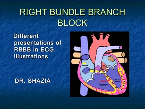 Right bundle branch block