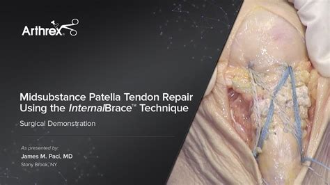 Arthrex Midsubstance Patella Tendon Repair Using The InternalBrace