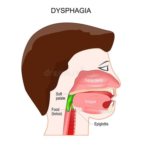 Dysphagia Aspiration Food Or Liquid Into The Lungs Stock Vector