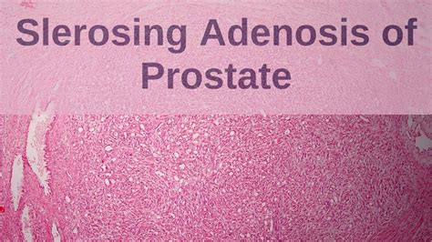 Sclerosing Adenosis Of The Prostate Pathology Mini Tutorial Youtube