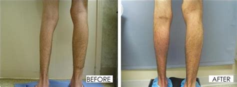 Calf Implant Images | Calves Augmentation | Chugay Cosmetic Surgery ...