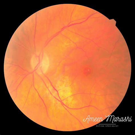 Full Thickness Macular Hole Stage Four