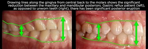 Managing Over Eruption Following Tooth Wear Spear Education