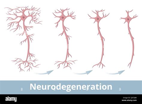 Neurodegeneration Degeneration Of A Nerve Cell That Occurs Because Of