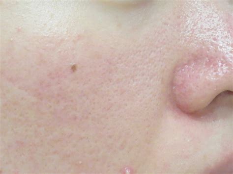 全顔治療 東京 渋谷 美容皮膚科 マグノリア皮膚科クリニック