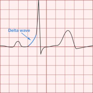 Differential Diagnosis of ECG Guide: Part II