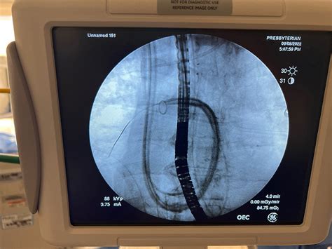 Technical Considerations For Percutaneous Pulmonary Artery Cannulation