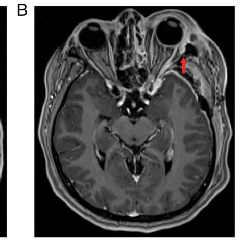 (A) Brain MRI with I/V contrast. The red arrow indicates a new ...