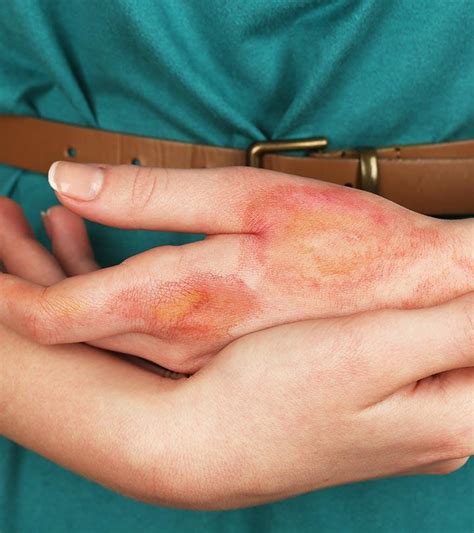 How To Treat Burns At Home 14 Natural Remedies To Try