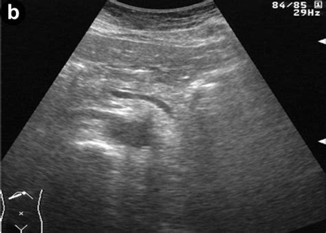 A Abdominal Ultrasonography Disclosed 1 3 Cm Multiple Low Echoic